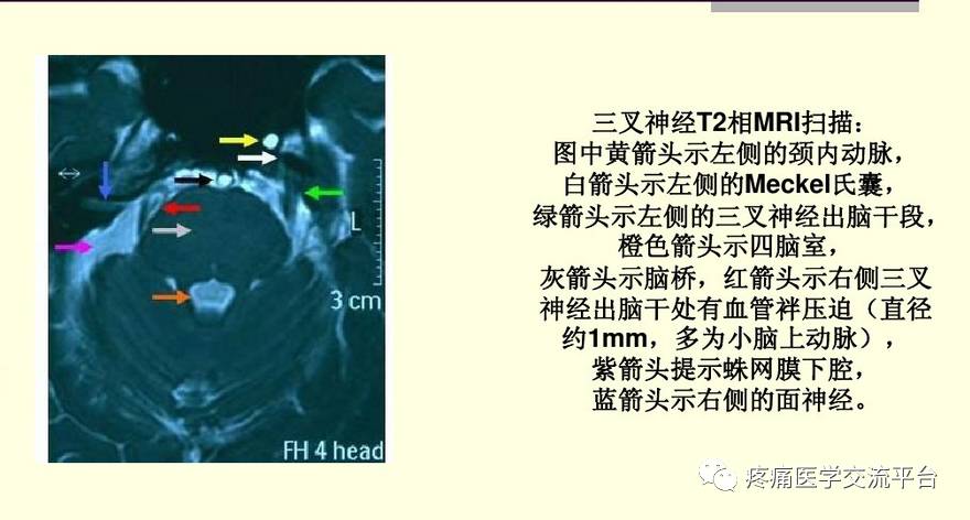 三叉神经解剖及mr表现