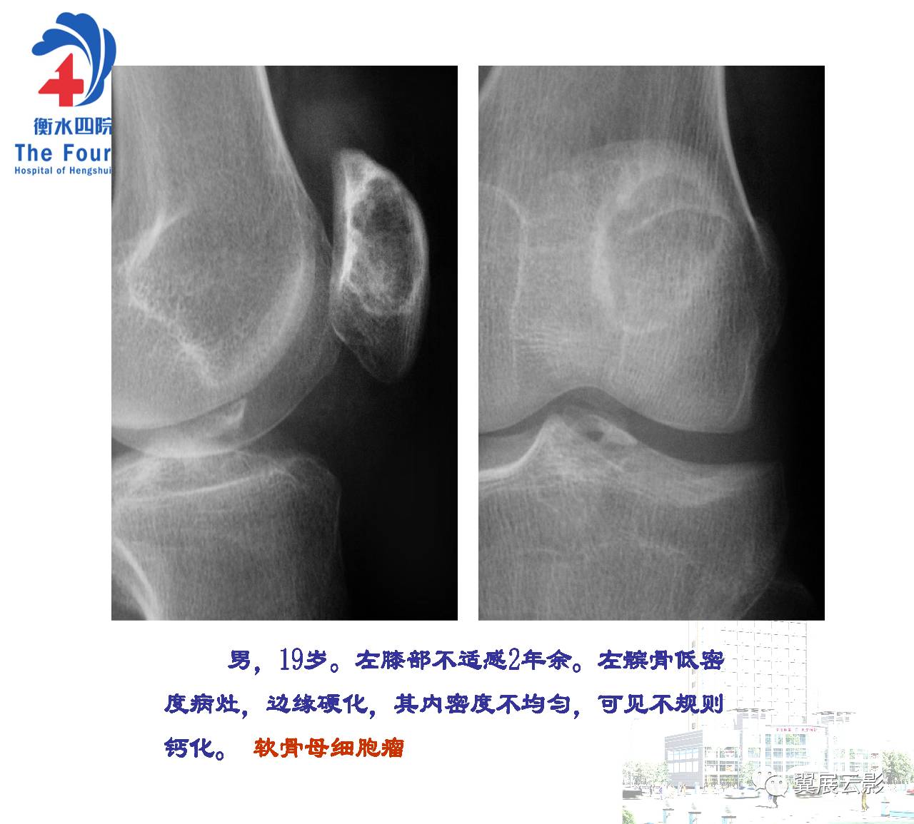 髌骨骨肿瘤及肿瘤样病变分析