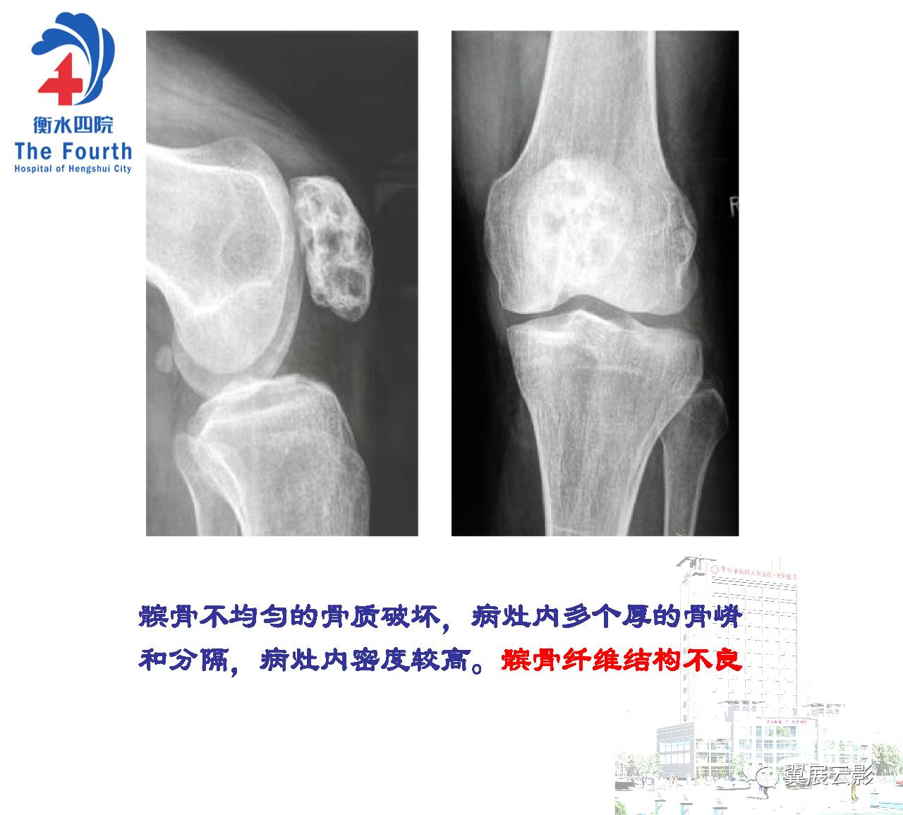 髌骨骨肿瘤及肿瘤样病变分析