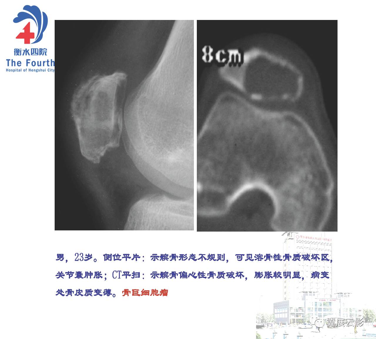 髌骨骨肿瘤及肿瘤样病变分析