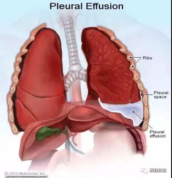 详解"胸腔积液"(形成机理及各类影像表现)