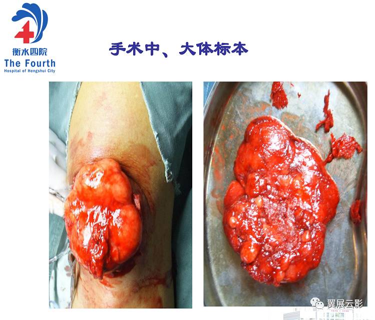 髌骨骨肿瘤及肿瘤样病变分析