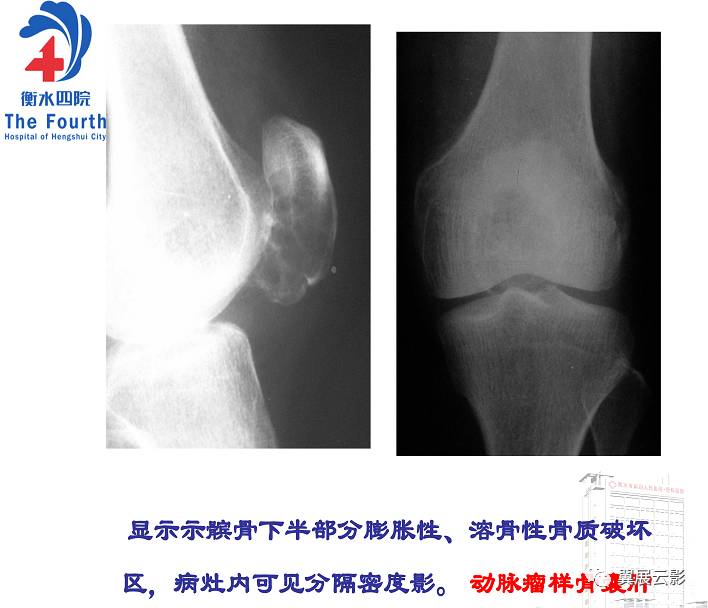 髌骨骨肿瘤及肿瘤样病变分析