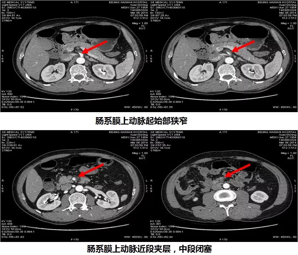 紧急行腹部增强ct发现,患者肠系膜上动脉起始部狭窄,近段夹层,中段