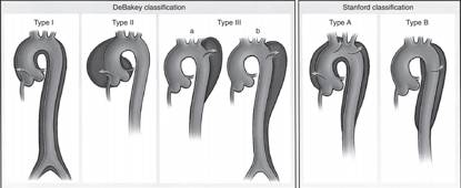 根据是否累及升主动脉,主动脉夹层可分为stanford分型,该分型自上