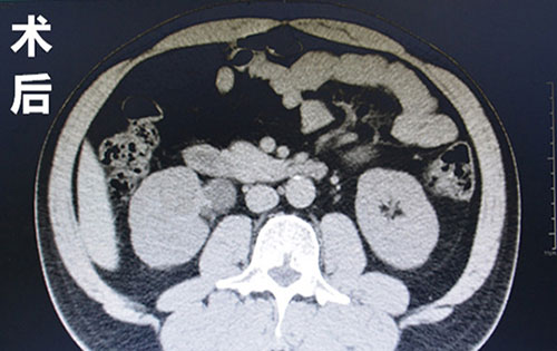 (右肾盂结石,右肾积水ct术前术后对比图)