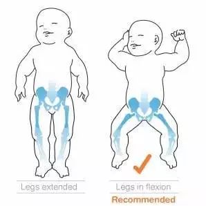 宝宝臀纹不对称，1岁后发现就晚了！ | 髋关节