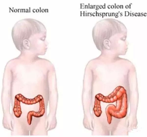 先天性巨结肠是一种先天性肠道畸形,患先天性巨结肠的宝宝,由于结肠或