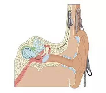 人工耳蜗植入位置示意图 返回搜