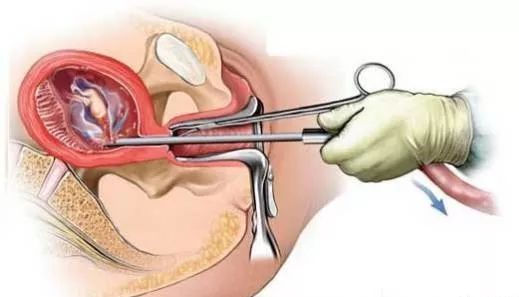 这就不难看出,流产对女性子宫伤害有多大