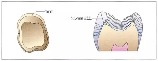 如果是制备健全牙,尽可能保存住牙本质,形态做成圆滑的凸型.