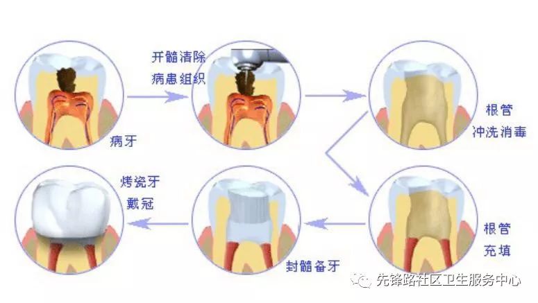 健康小常识 |正确认识"根管治疗"