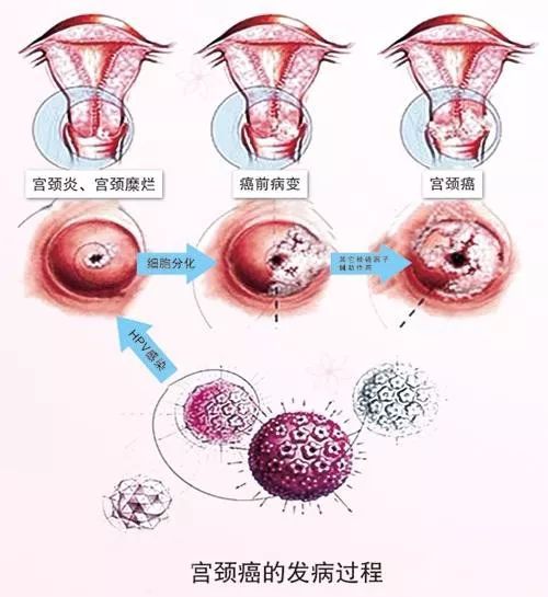 "宫颈癌"背后,不为人知的故事.