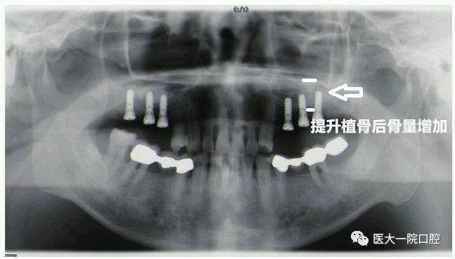 骨量不足怎么办