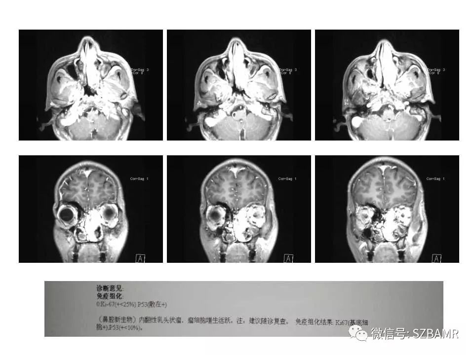 鼻腔鼻窦解剖及常见病变影像诊断(一)