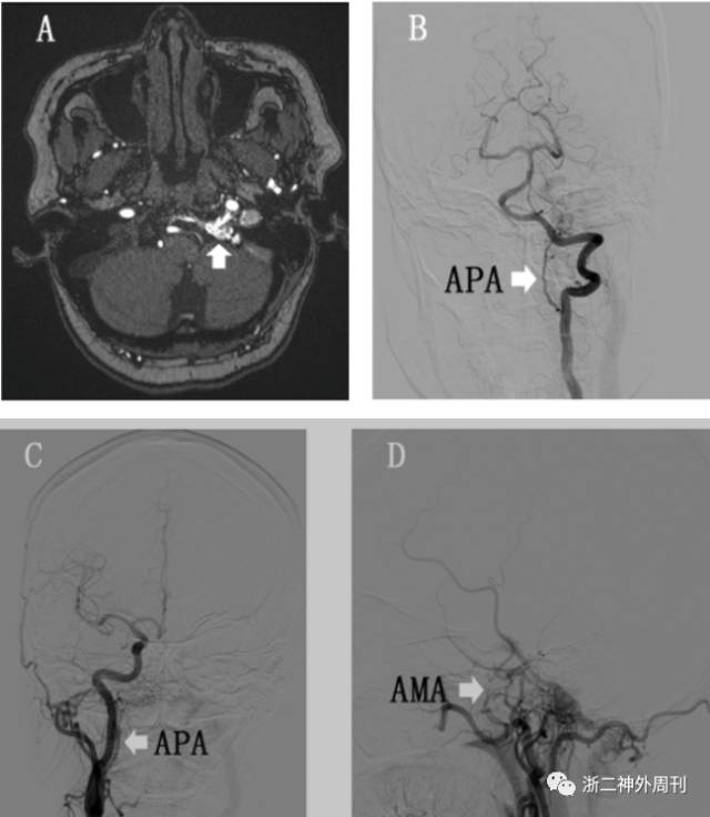 静脉入路栓塞舌下神经管区硬脑膜动静脉瘘一例-浙