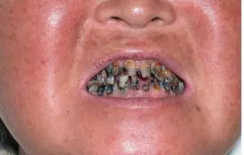 牙齿龋坏还应该尽快去找口腔医生做修补如因此造成缺牙在口腔环境已经