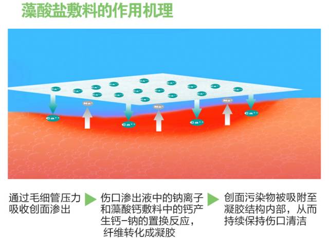 鼻腔手术填塞使用藻酸盐敷料与膨胀海绵的对比