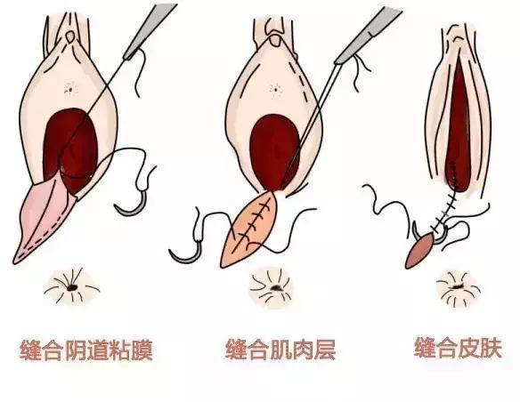 可怕,顺产下面还要被剪一刀,会影响"性福"吗?