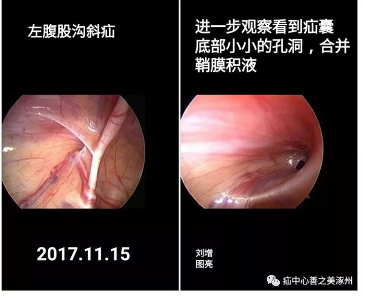 小儿腹股沟疝合并鞘膜积液的腹腔镜微创治疗