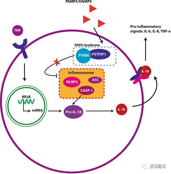 【综述】坏疽性脓皮病:病理生理学,诊断和治疗新进展