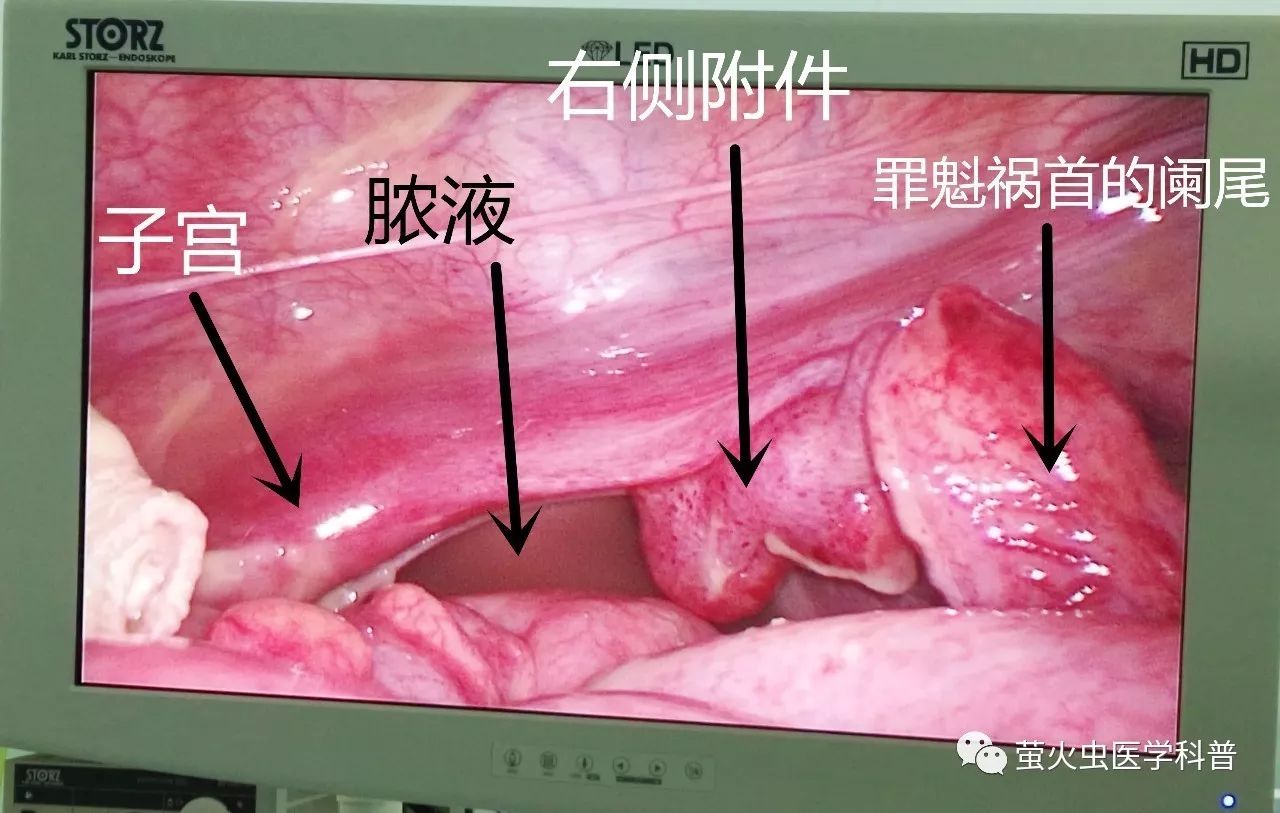 3. 粪石是阑尾急性发炎的元凶,平时的饮食不干净,是诱因. 4.