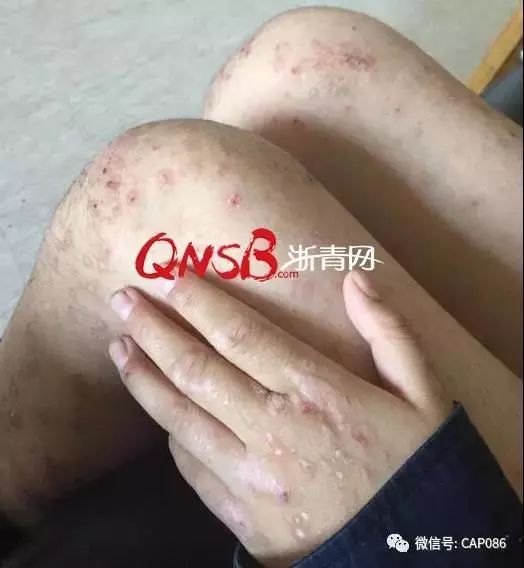 义蓬一小多名学生因甲醛超标呕吐,起皮疹 校长被免职