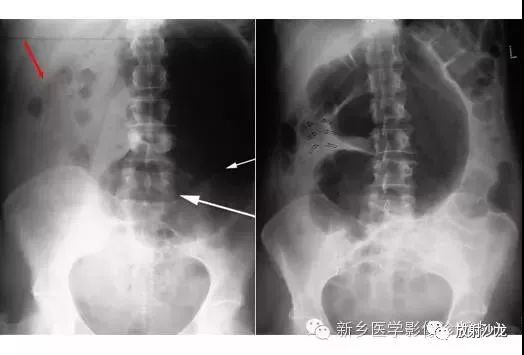 详细腹部平片解剖 正常表现 读片技巧 病例分析