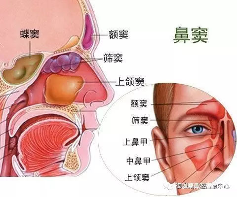 急性化脓性鼻窦炎的病因和诊断!佛山市炏焱健康管理