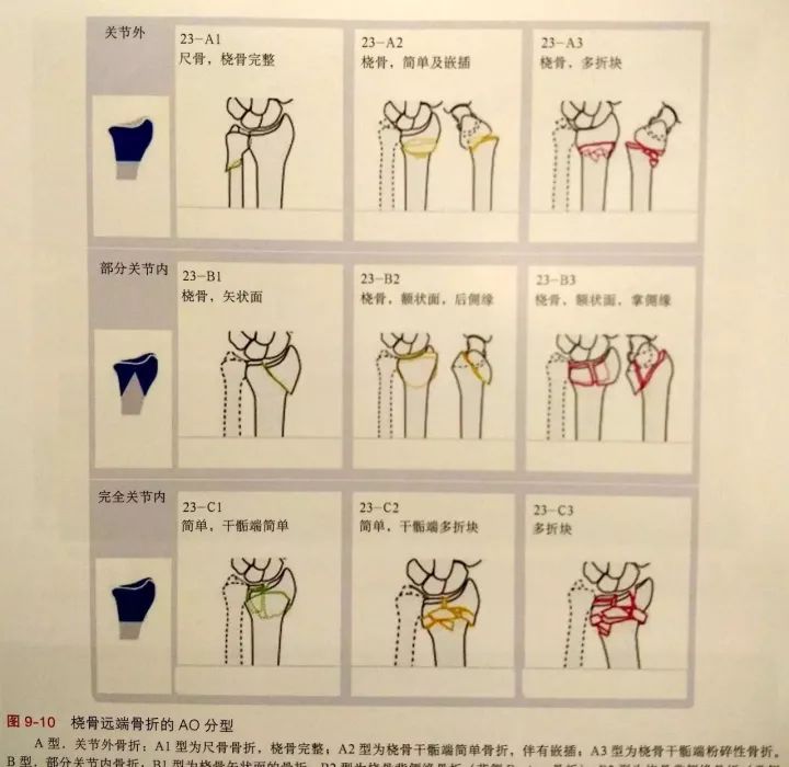 10 桡骨远端骨折 fernandez分型 11 桡骨头骨折 改良mason分型 型 