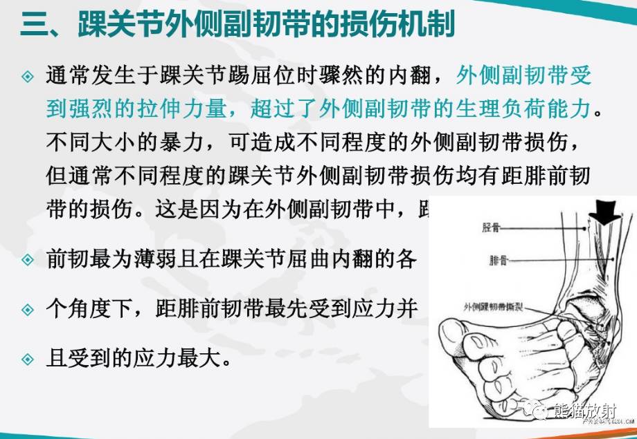 跟腓韧带或距腓前韧带损伤,中度疼痛,肿胀,关节不稳;iii,跟腓韧带和距