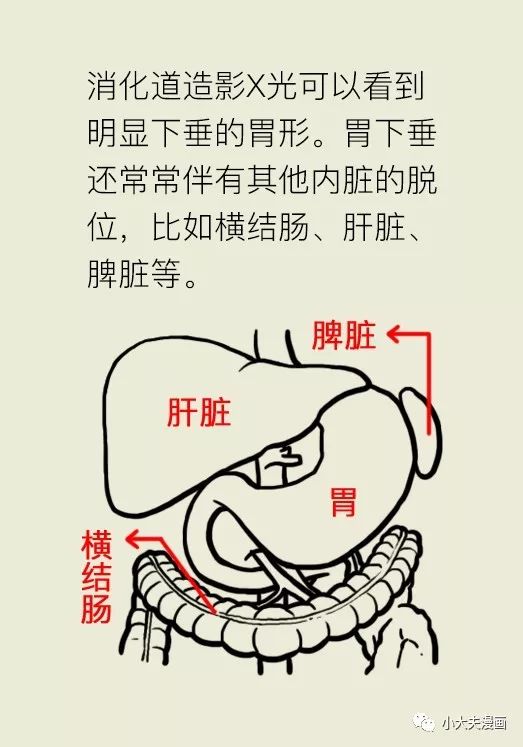 "饭后运动会胃下垂"的传说到底是不是真的?