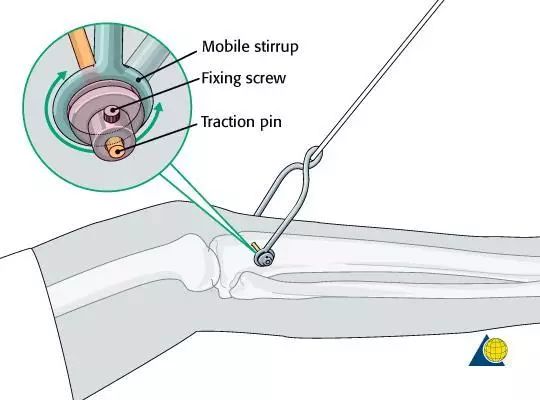 11a 胫骨骨牵引