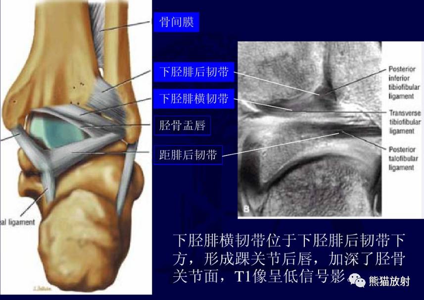 三角韧带属于复合韧带,呈扇形结构,由浅层和深层组成.