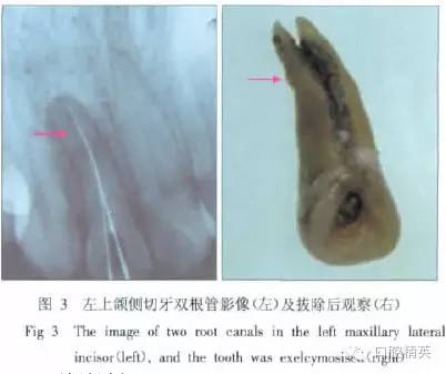 x线牙片在牙齿疑难病例诊断中的参考价值