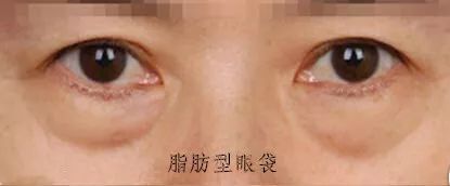 2,肌肉型眼袋 眼部肌肉肥厚(眼轮匝肌)所致,形似眼袋,也是遗传发育所