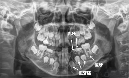 乳牙做根管治疗,到底有多恐怖?