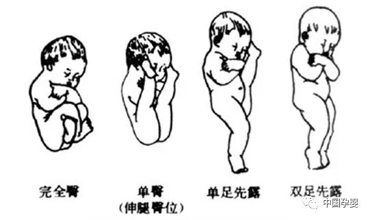 臀位: 如果胎儿头和臀颠倒过来,臀在下头在上,是臀先露,这种胎位叫