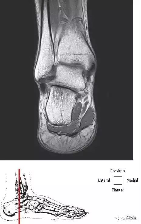 【解剖】踝关节系统解剖图 冠/矢/轴mri
