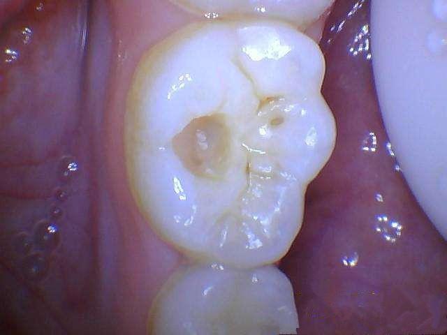 1)牙齿烂到牙髓,牙髓受到细jun感ran,引起牙髓炎,出现剧烈疼痛,这时