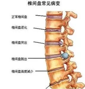 注意预防腰椎间盘突出!