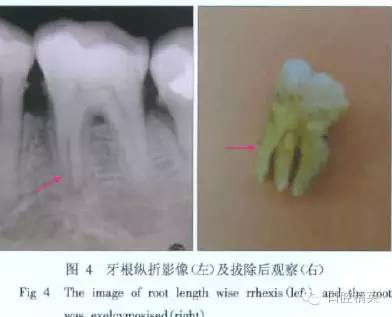 x线牙片在牙齿疑难病例诊断中的参考价值