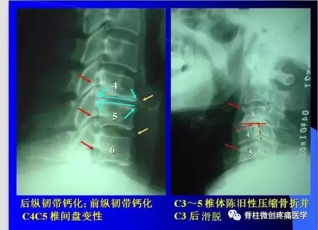 1颈曲,2椎间隙,3椎体前缘骨赘,4关节突关节,5环椎前结节,6环椎后弓,7