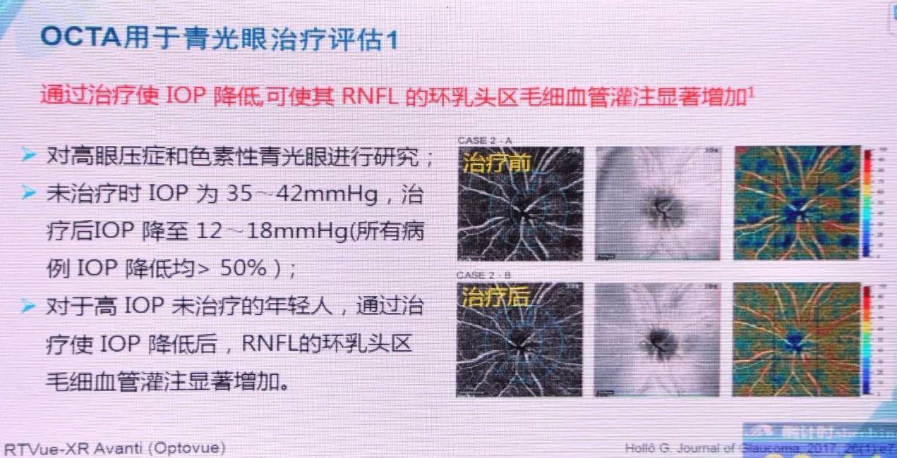 octa:青光眼全程监控的一大利器