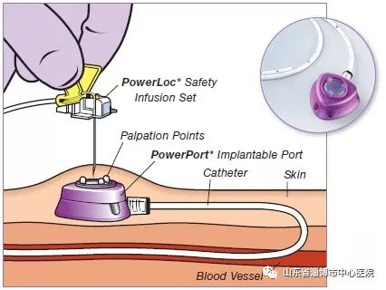 静脉输液港是目前国际上首选的可植入皮下长期留置的体内静脉输液装置