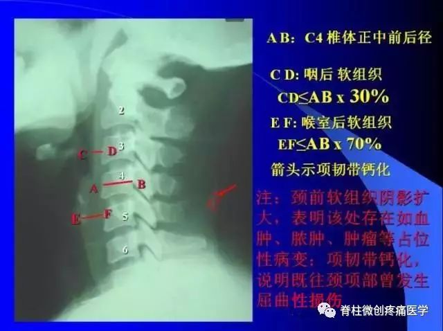 脊椎病的x光片解析集合