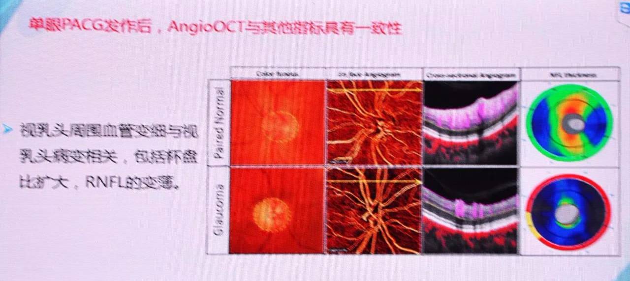 octa青光眼全程监控的一大利器