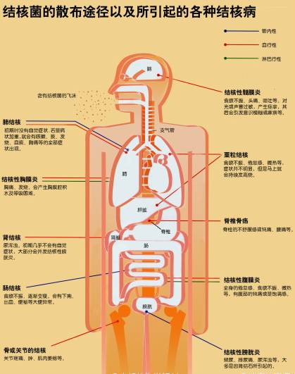 结核菌人口_结核菌素试验阳性图片