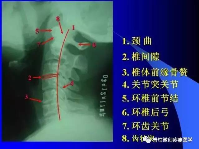 科技 正文  后纵韧带钙化;前纵韧带钙化;椎间盘变性;椎体陈旧性压缩