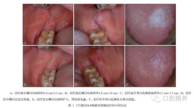 5 cm大小有光泽的白色斑块,平伏,扪质软(图1c),上述各损害均无明显